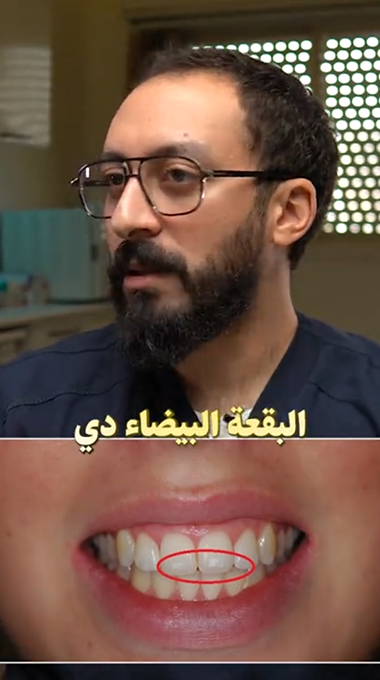 البقع البيضا على الاسنان